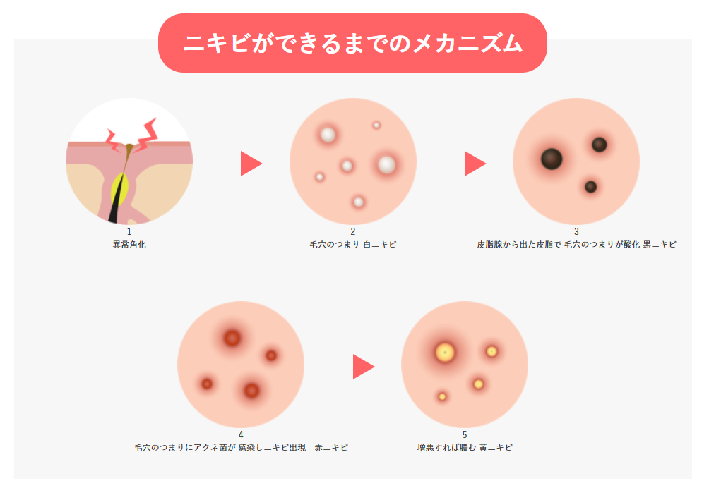 ニキビができるメカニズムを順に説明した図