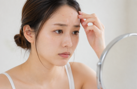 おでこのニキビを気にしている女性
