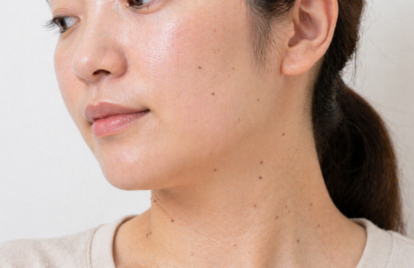 顔から首にかけてイボがある女性
