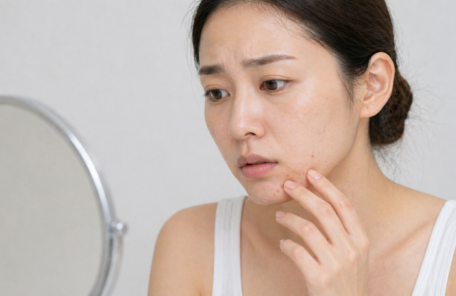 顎のニキビを気にして顔を触っている女性