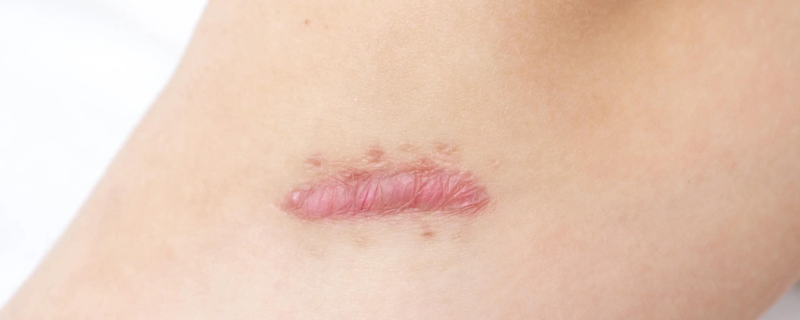 What is a keloid?