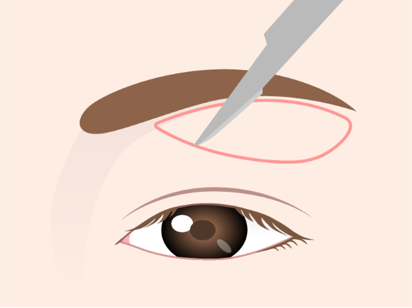 Incision