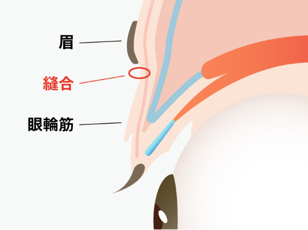 Procedure
