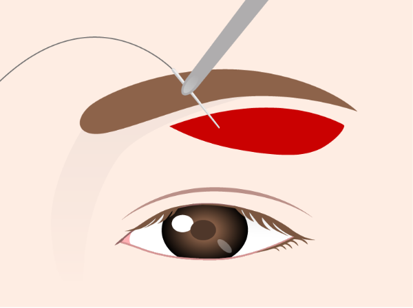 Suturing