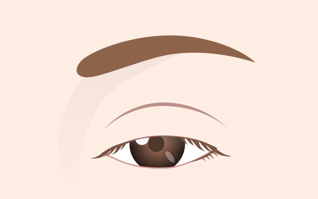 Mild ptosis