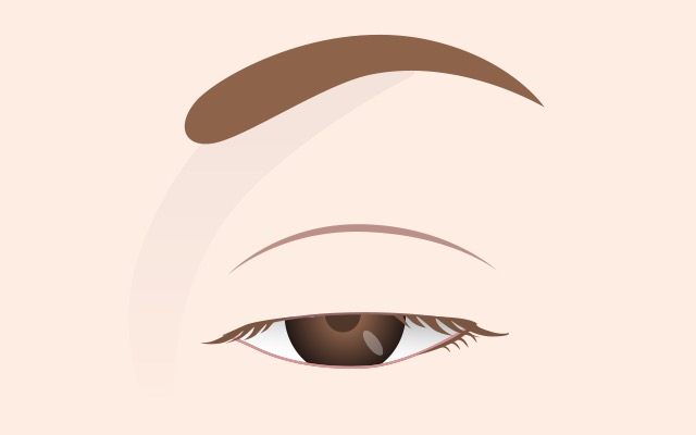 Normal eyelid opening