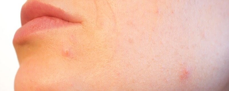 Illustration of dark pores