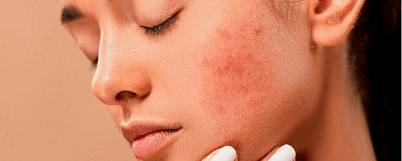 Illustration showing typical symptoms of skin tags, including small soft growths on the neck and underarms