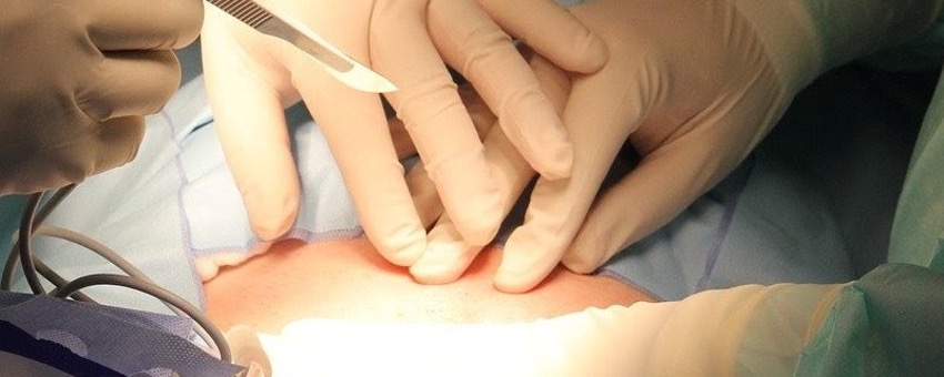 Overview image of the four wart treatment methods