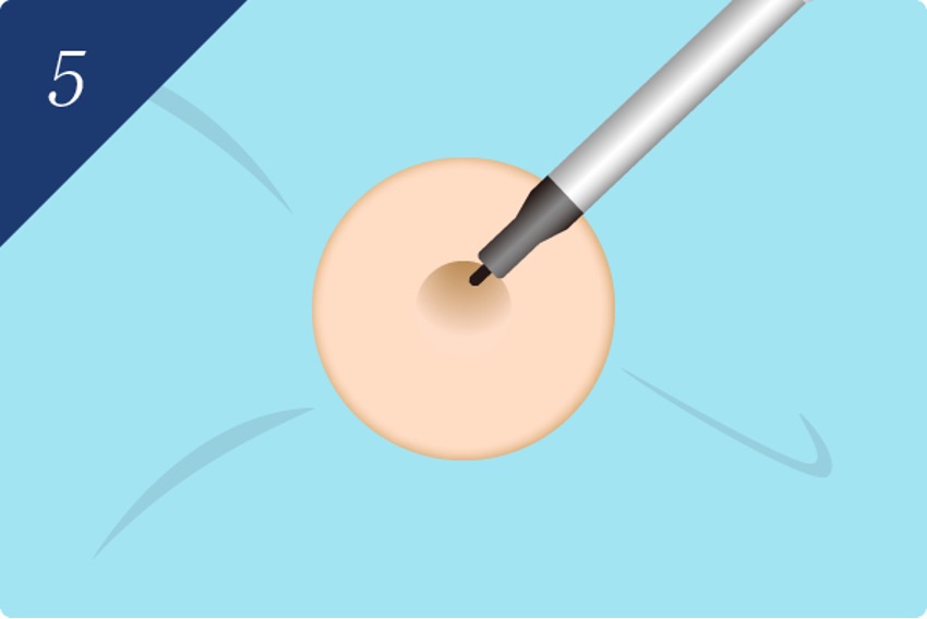 Step 5: Proposal of CO2 laser treatment