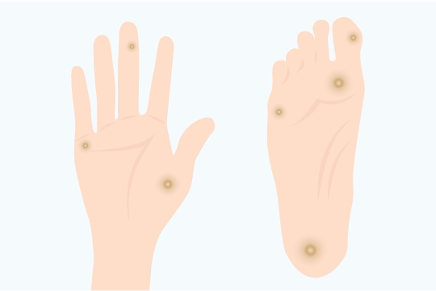 Illustration of verruca vulgaris (common wart)