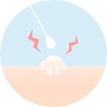 Drawback 1 of cryotherapy: pain during treatment
