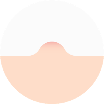 Drawback 2 of cryotherapy: possible spread of warts