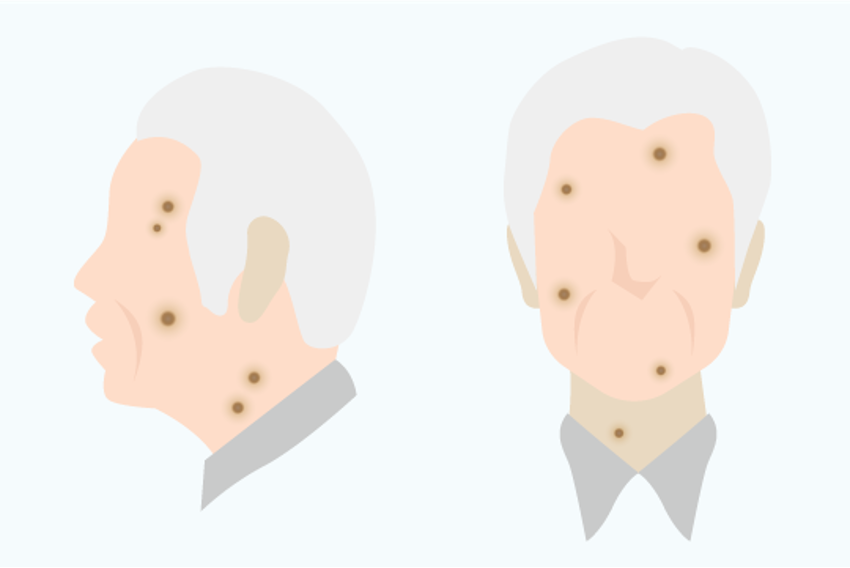 Illustration of seborrheic keratosis (age-related wart)