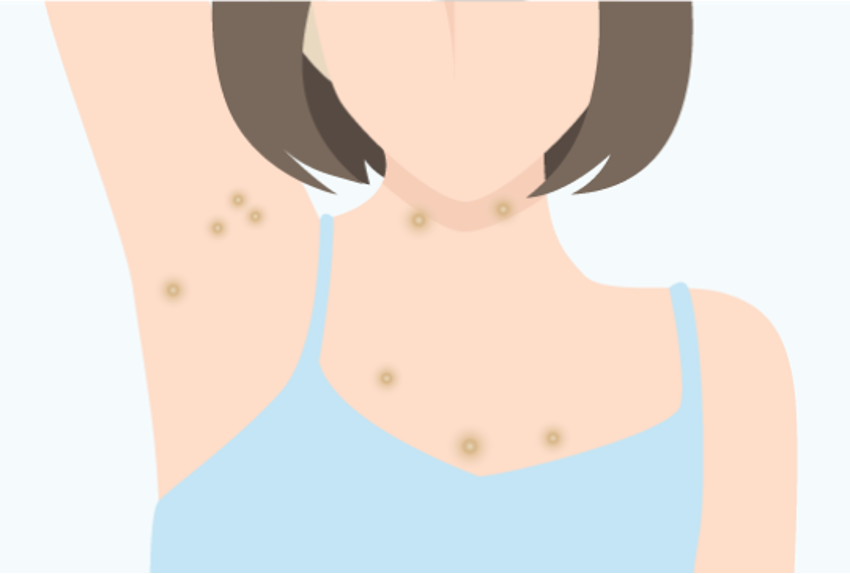 Illustration of acrochordon (skin tags on neck, underarms, and chest)