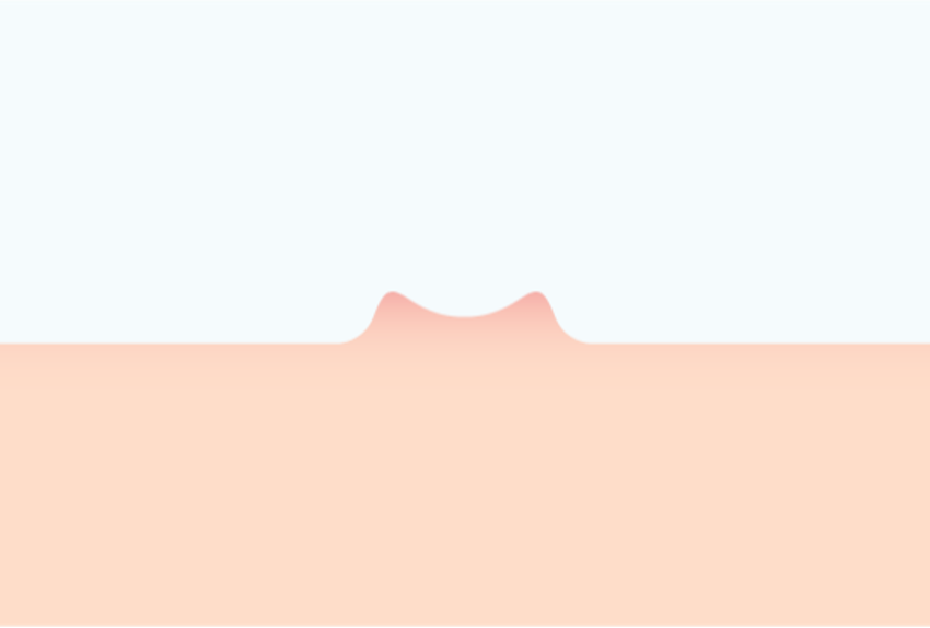 Illustration of myrmecia (deep plantar wart)